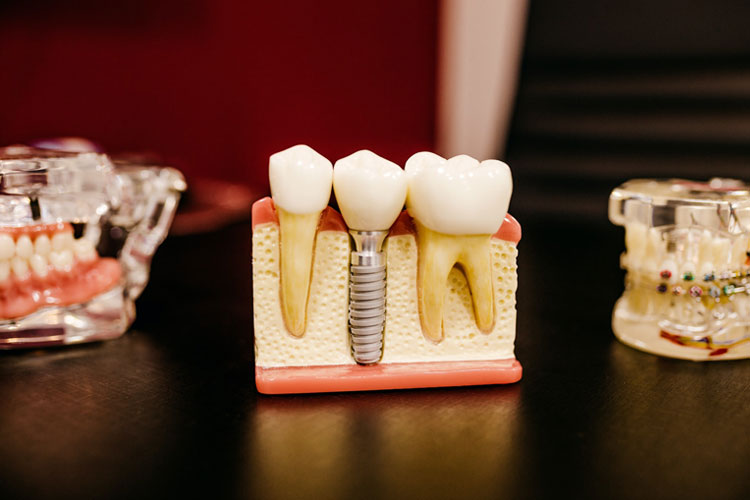 Dental Implants