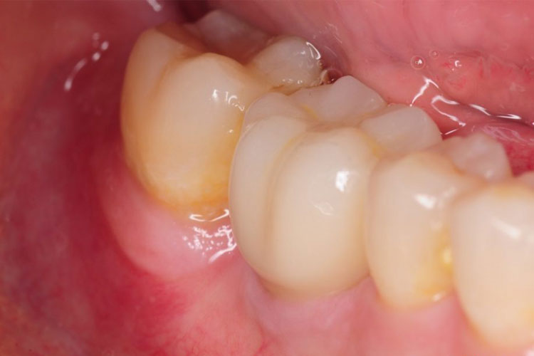 Tooth Color Restoration