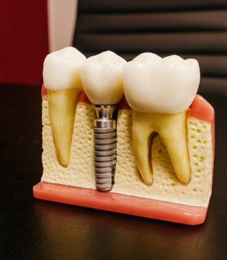 DENTAL IMPLANTS